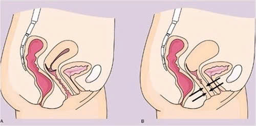 Cách xử lý khi quan hệ bị mắc kẹt hiệu quả